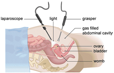 Laparoscopy